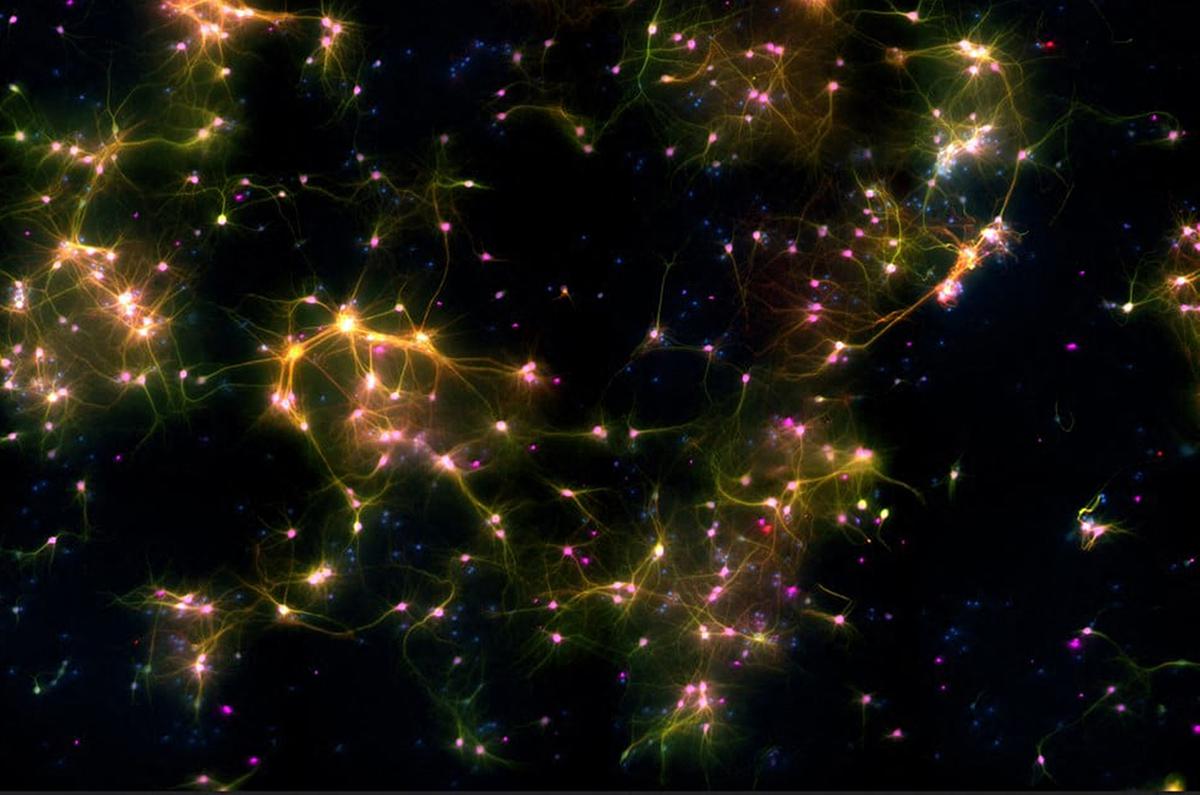 Effects of neural precursor cells’ abnormal migration