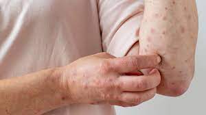 Centre releases three-drug regimen for treating leprosy