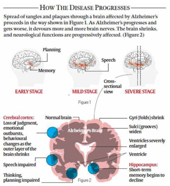 Scientist makes breakthrough in Alzheimer’s drug research
