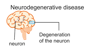 First step in treating some neurodegenerative disorders
